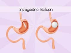 Balón gástrico ¿En qué consiste? Balón gástrico
