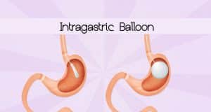 Balón gástrico ¿En qué consiste? Balón gástrico