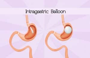 Balón gástrico ¿En qué consiste? Balón gástrico