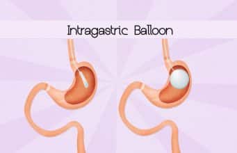 Balón gástrico ¿En qué consiste? Balón gástrico