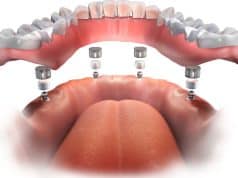 Tipos de implantes dentales Implantes dentales técnica all in 4