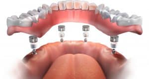 Tipos de implantes dentales Implantes dentales técnica all in 4