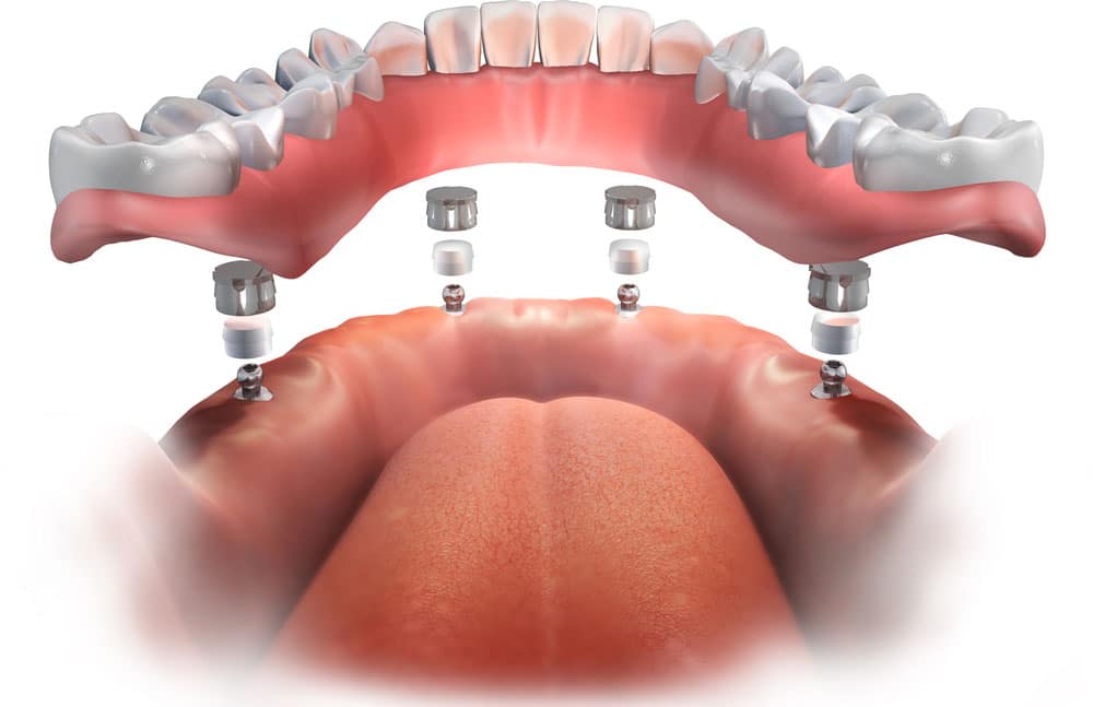 Implantes dentales técnica all on 4
